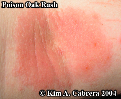 Poison
                      oak rash on my inner arm. Photo copyright by Kim
                      A. Cabrera 2004.